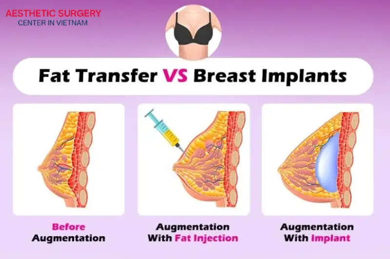 Fat transfer breast augmentation uses fat harvested from your own body to enhance breast size