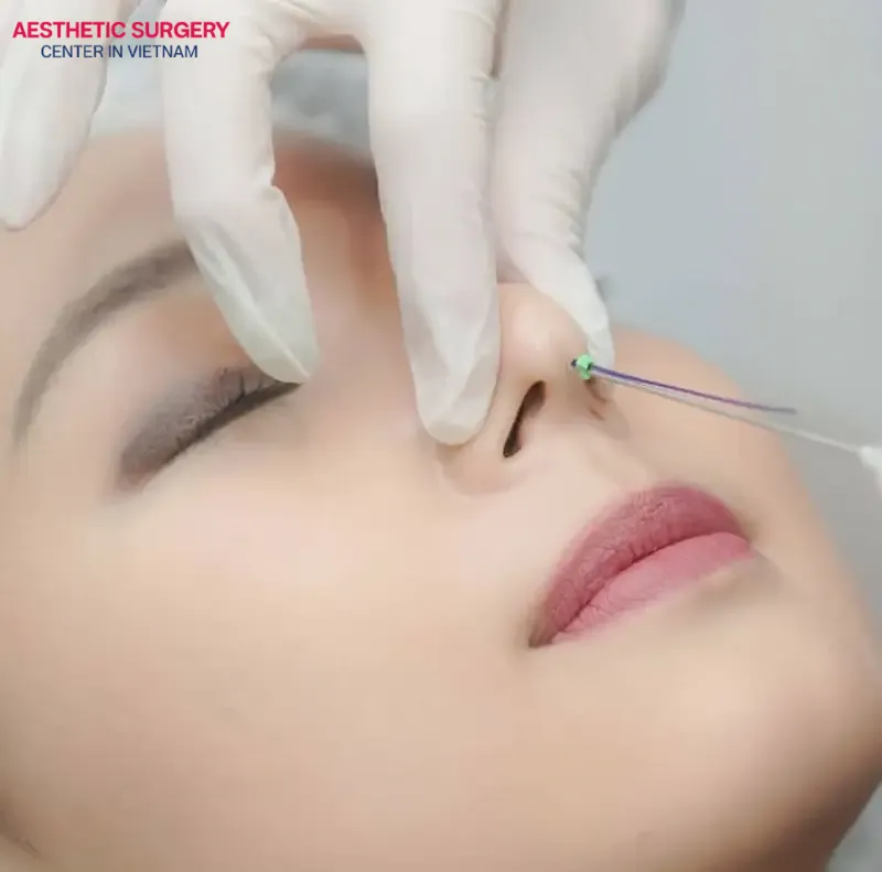 Using threads for nonsurgical rhinoplasty delivers quick aesthetic results without long downtime