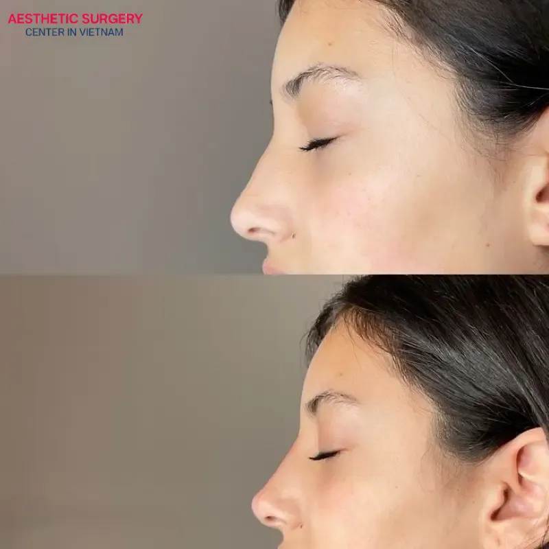 The aesthetic improvement of a mildly humped nose shape was effectively achieved after the procedure