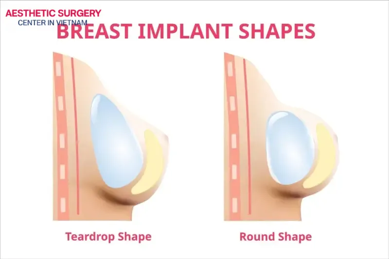 Teardrop and round implants deliver different aesthetic results depending on each person’s needs and preferences