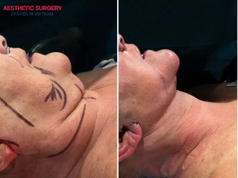 Immediately after surgery, the treated area may be swollen and quite painful