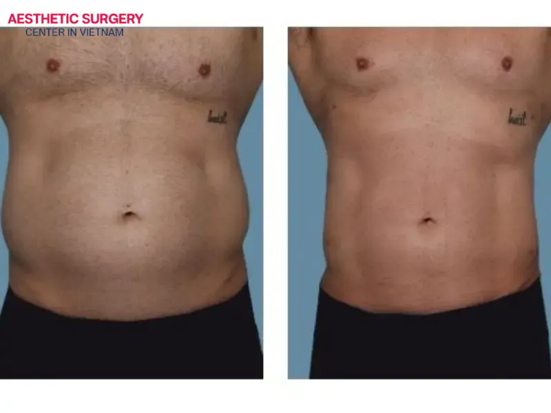 Waist liposuction creates a slimmer, more masculine waistline