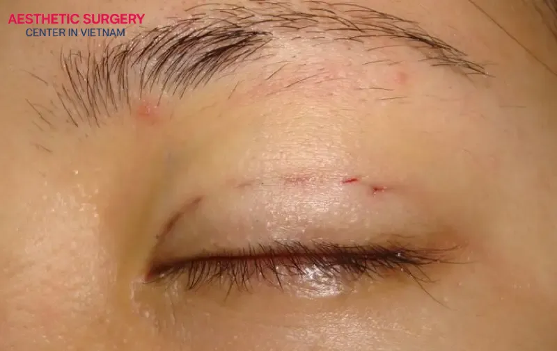 Swelling will subside and the doctor may remove  the stitches about 1 week after the procedure