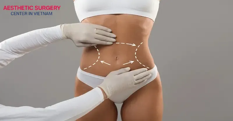 The mini tummy tuck targets the excess skin and fat in the lower belly area