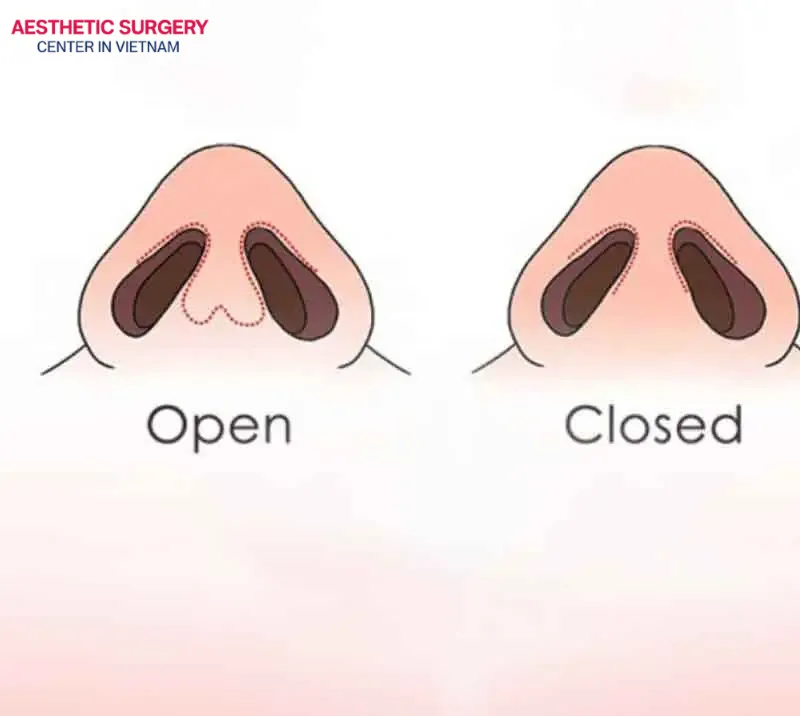 Both open and closed rhinoplasty have their own advantages and disadvantages