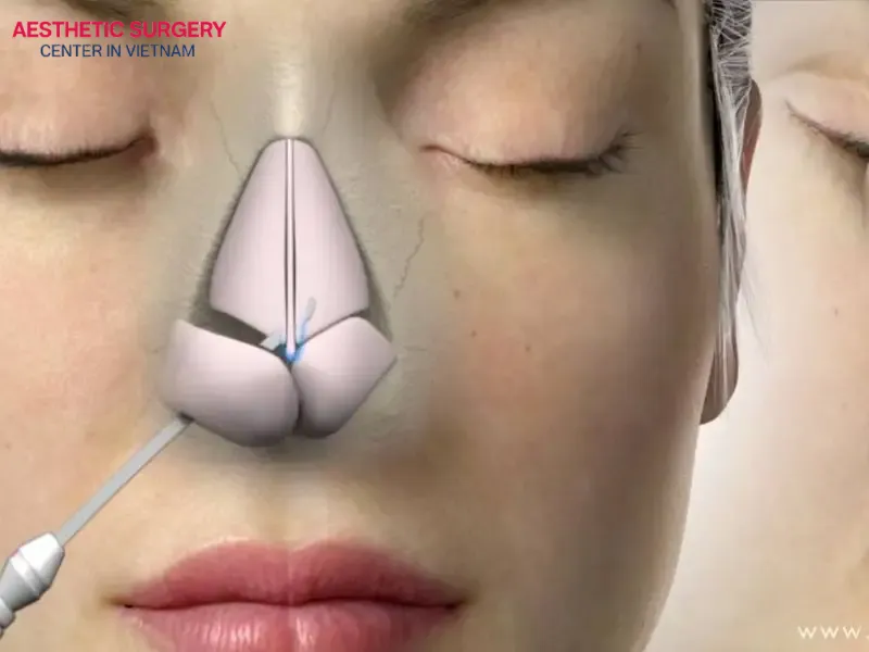 Open rhinoplasty involves deep structural intervention, allowing for highly accurate reshaping of the nose