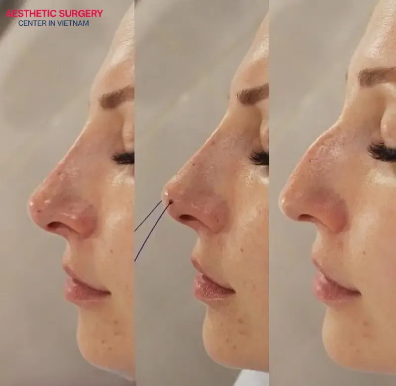 Thread lift rhinoplasty helps shape a high, straight nose using bio-threads without surgical intervention