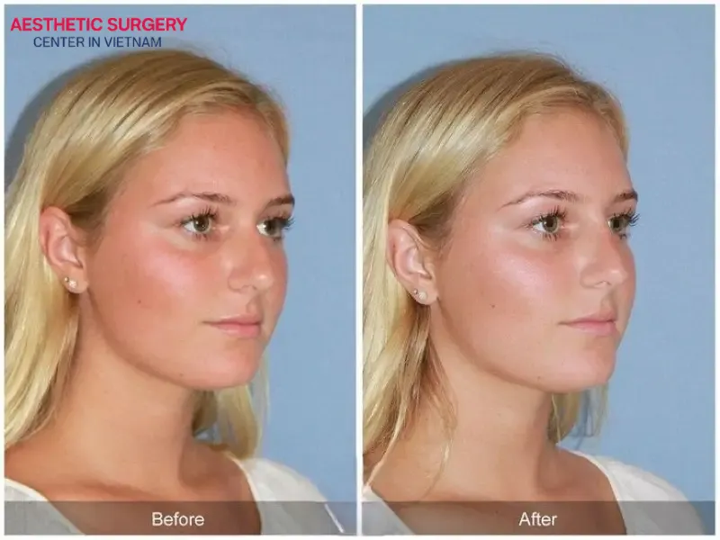 A humped nose shape was effectively corrected after liquid rhinoplasty