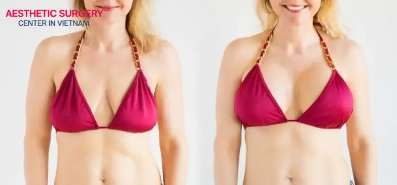 How much does breast augmentation cost in Vietnam? The breast augmentation cost in Vietnam ranges from 55 to 160 million VND, influenced by various factors
