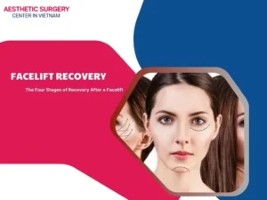Facelift recovery