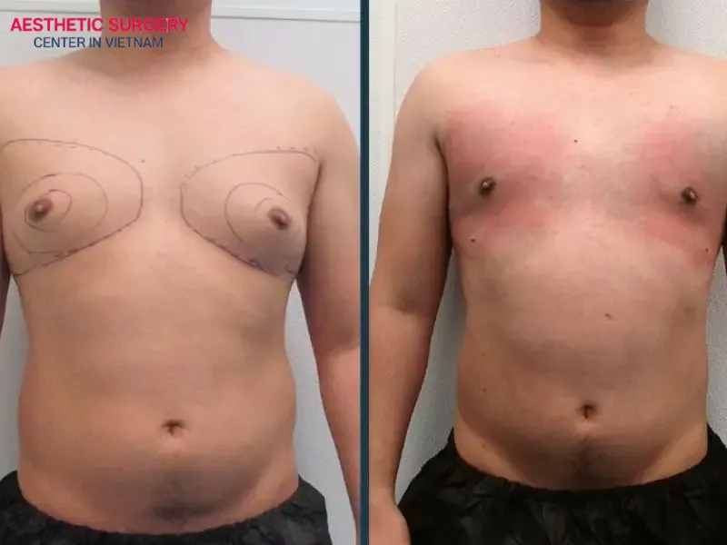 Male liposuction costs are influenced by several factors
