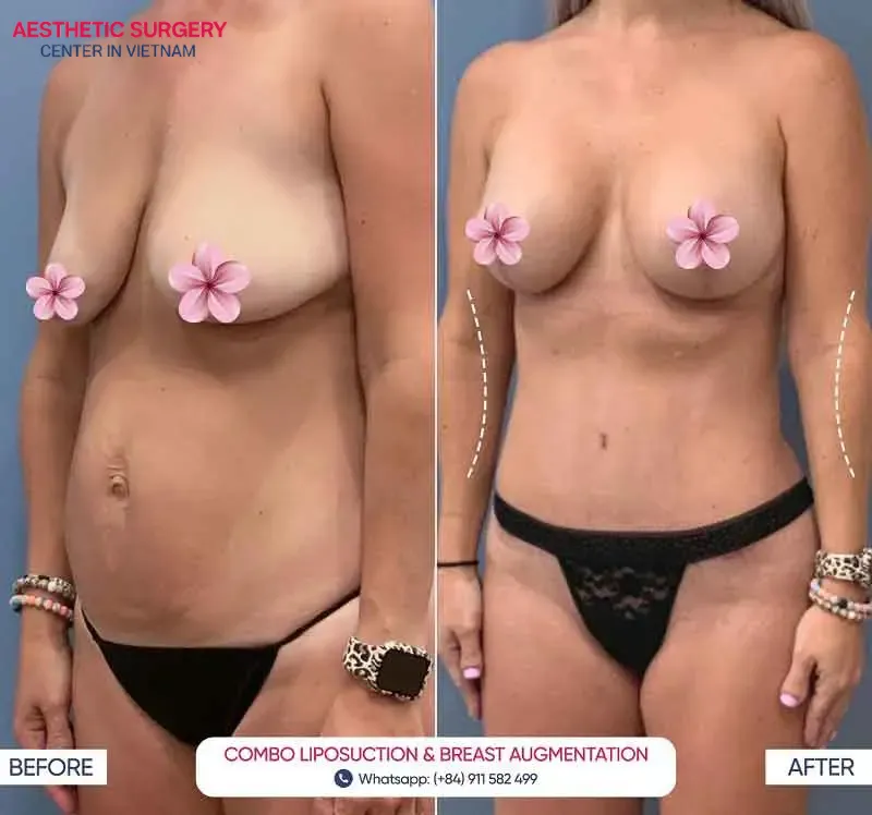Images of a client before and after breast augmentation at Aesthetic Surgery Center