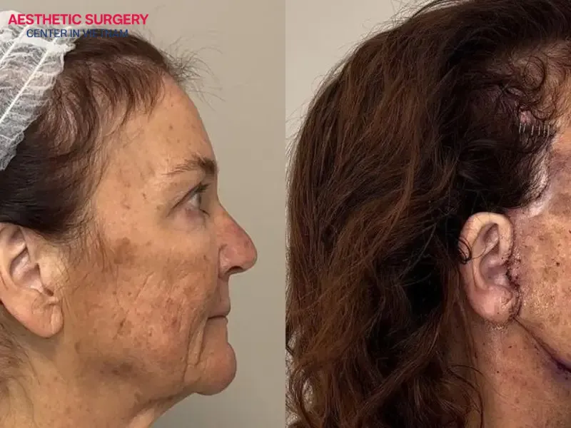 While a facelift delivers noticeable results, it also carries certain risks that you should be aware of