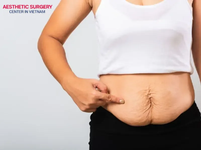 Lumpy, uneven skin is a typical complication following poorly performed liposuction