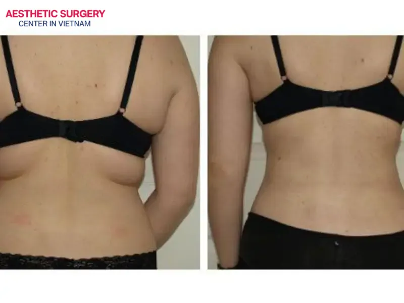 Without consistent training and weight management, back fat may return even after liposuction