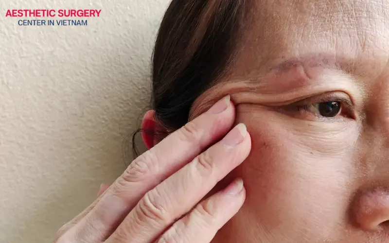 Aging is one of the key factors leading to droopy eyelids that negatively affect facial aesthetics