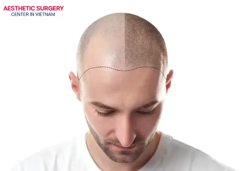 Hair transplant is not painful and can deliver long-term results