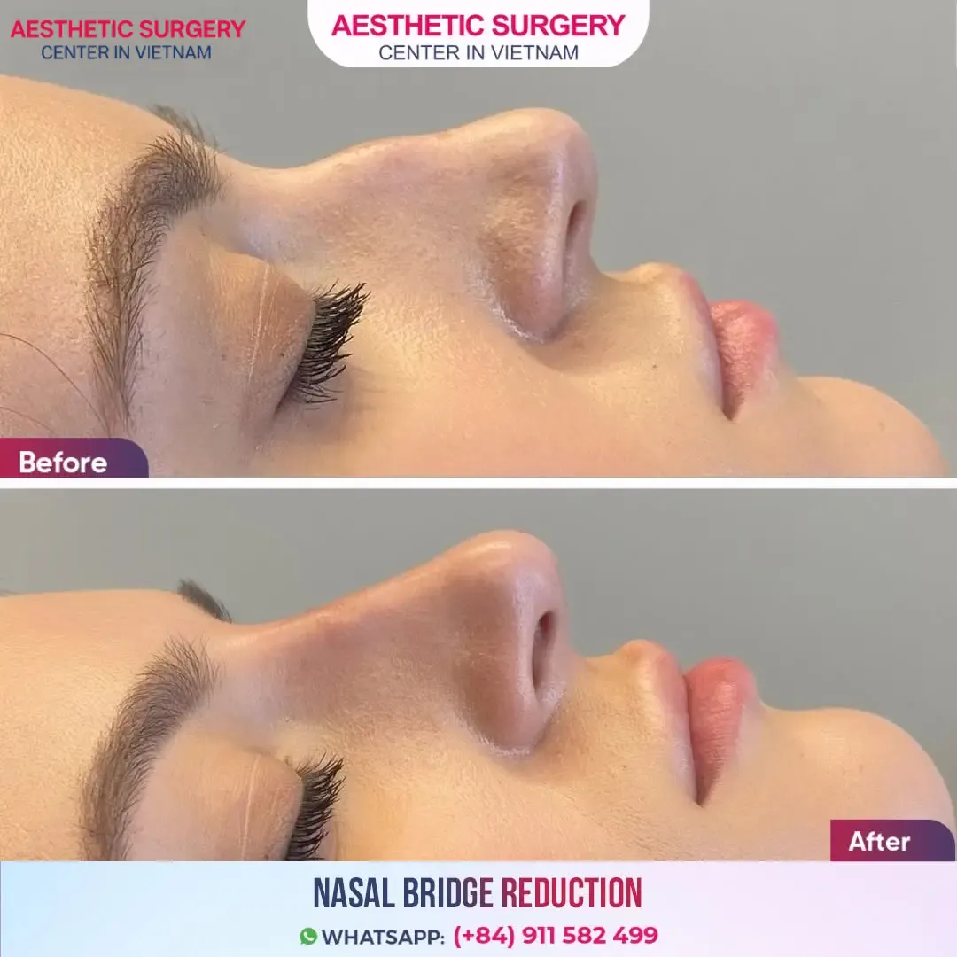 Before and after images of a nonsurgical rhinoplasty showing enhanced nose aesthetics at Aesthetic Surgery Center