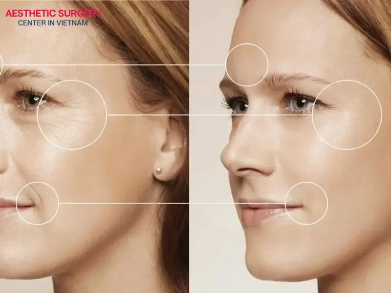 Recovery time after a ponytail facelift is generally faster than other methods due to its minimally invasive nature
