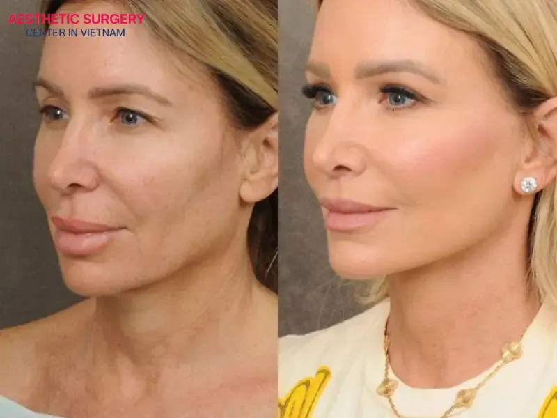 Aesthetics Surgery Center is a trusted facelift clinic in Vietnam, chosen by many clients