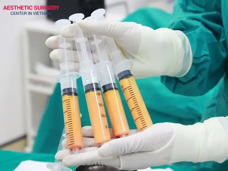 Fat transfer is a widely recommended method to improve results after botched liposuction