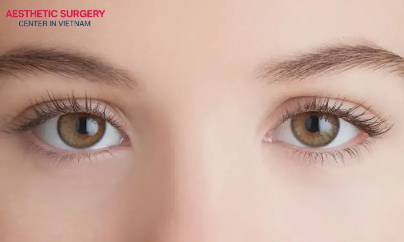 Tips to help you significantly reduce the cost of double eyelid surgery in Vietnam