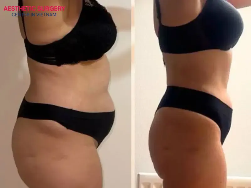 To achieve lasting fat reduction in the thighs and hips, pair liposuction with focused exercises for these muscle groups