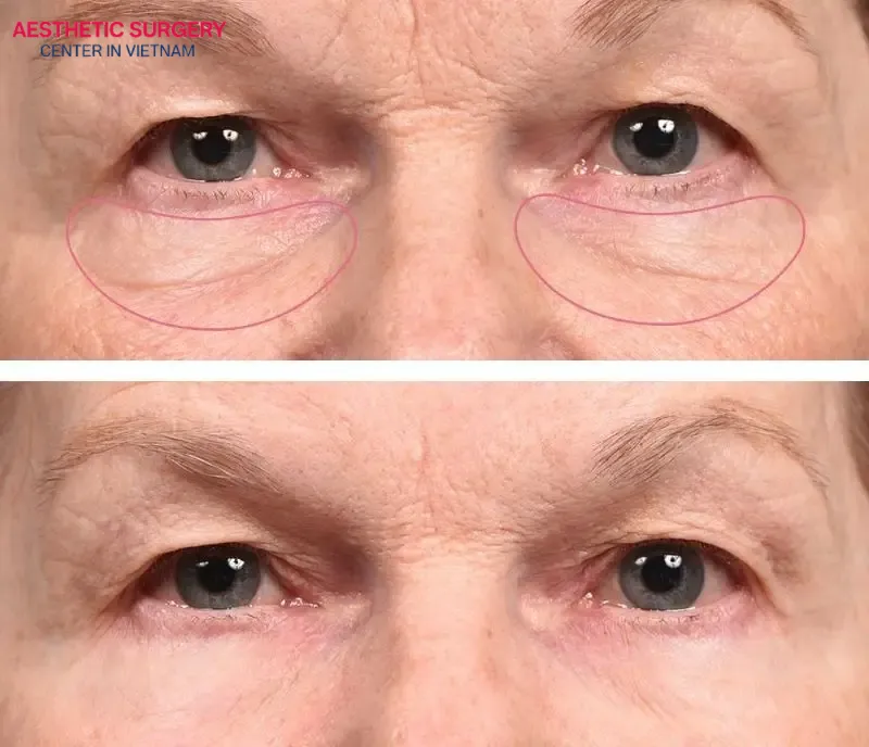 The client’s eyelids before and after undergoing the eyelid surgery procedure