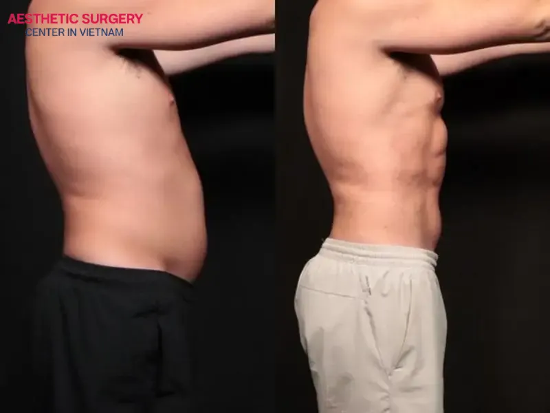 Liposuction for men has been proven effective, especially in eliminating stubborn fat quickly