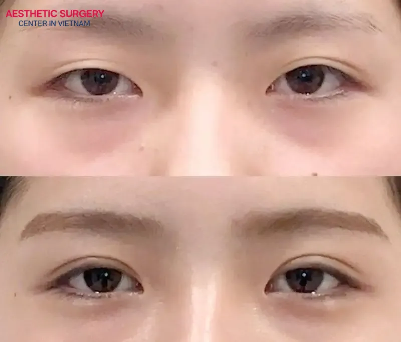The client’s eyes appear brighter, more refreshed, and more youthful after the procedure