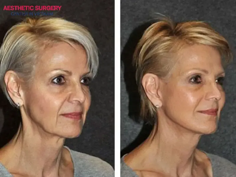Facelift prices are not fixed and may vary depending on several factors