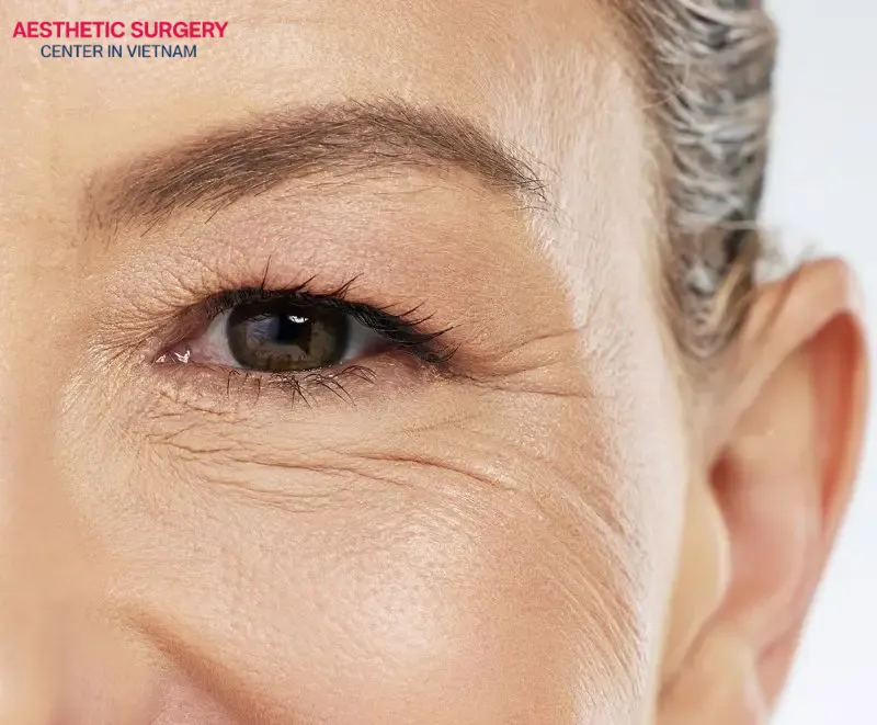 Those showing early signs of aging around the eyes are the ideal candidates for a brow lift