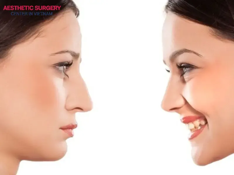 Visible improvements to nasal structure are typically noticeable immediately after the procedure