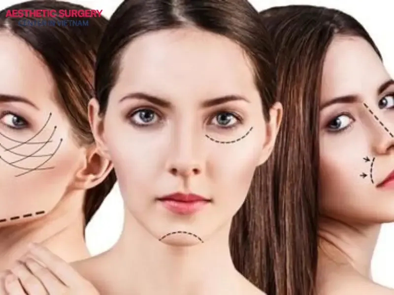 Facelift, by targeting the deeper subcutaneous tissues, provides long-lasting rejuvenation effects