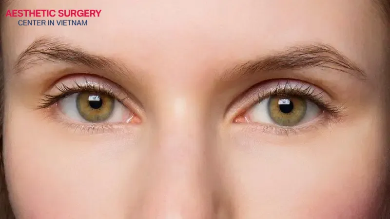 Choosing Vietnam for double eyelid surgery offers an incredibly cost-effective option for many clients seeking the procedure