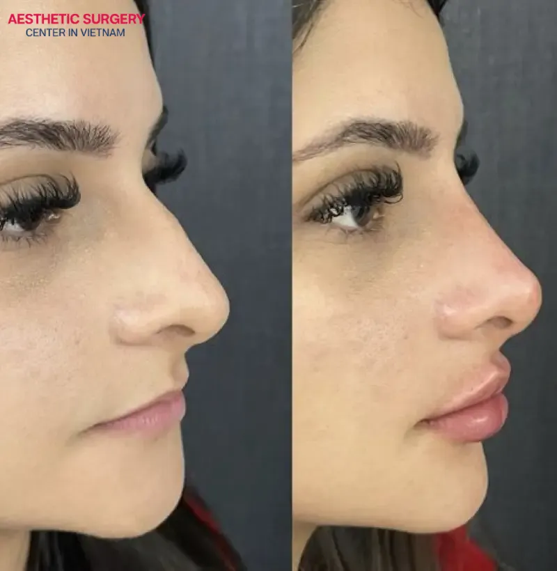 Before and after images of a nonsurgical rhinoplasty showing smoother correction of a humped nose