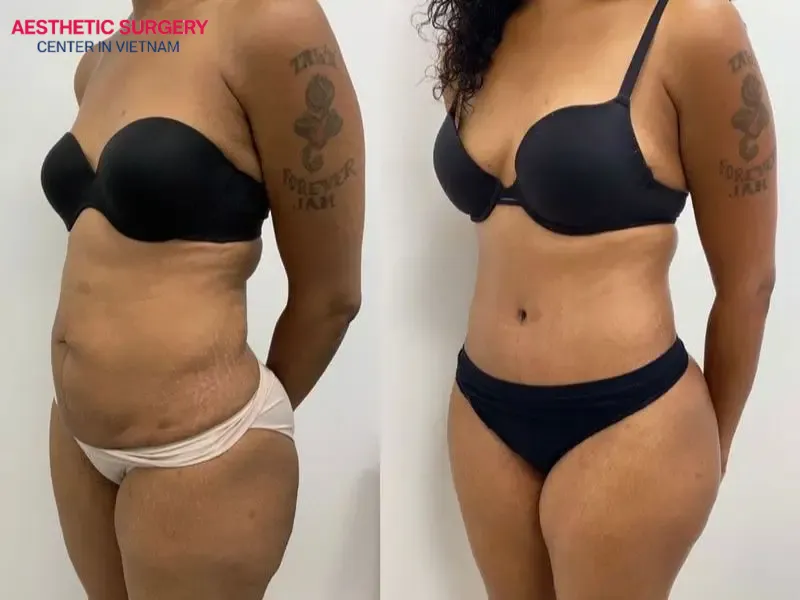 The abdomen is a common area for fat accumulation, which makes it especially important to care for properly after liposuction
