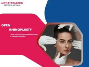 Open rhinoplasty