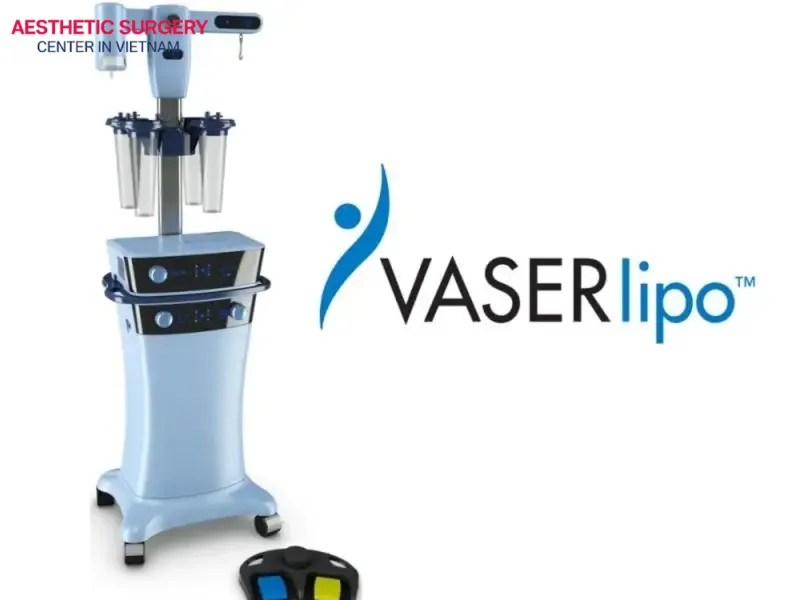 VASER liposuction uses ultrasound waves to liquefy adipocytes