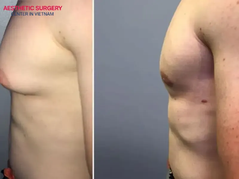 Chest fat often affects body aesthetics and confidence