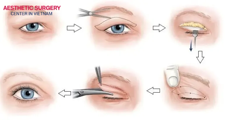 Find out the double eyelid surgery cost in Vietnam, giving you a more youthful and dynamic appearance