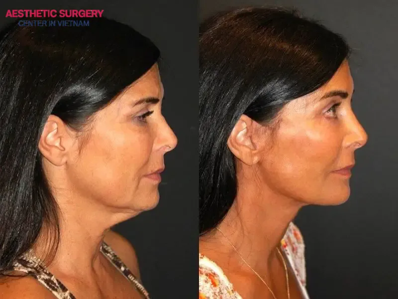Understanding the risks of deep plane facelift and choosing the right clinic are key to achieving your desired results