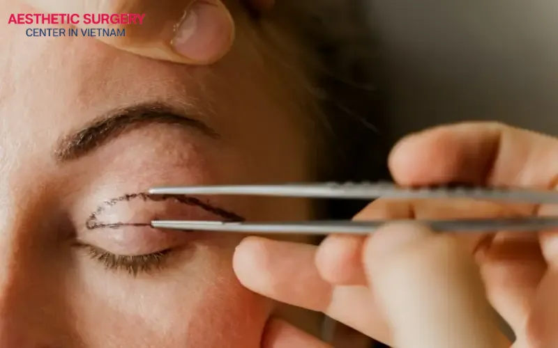 What is blepharoplasty? Blepharoplasty is a procedure that removes excess skin around the eyelids and enhances facial aesthetics