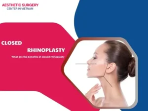 Closed rhinoplasty