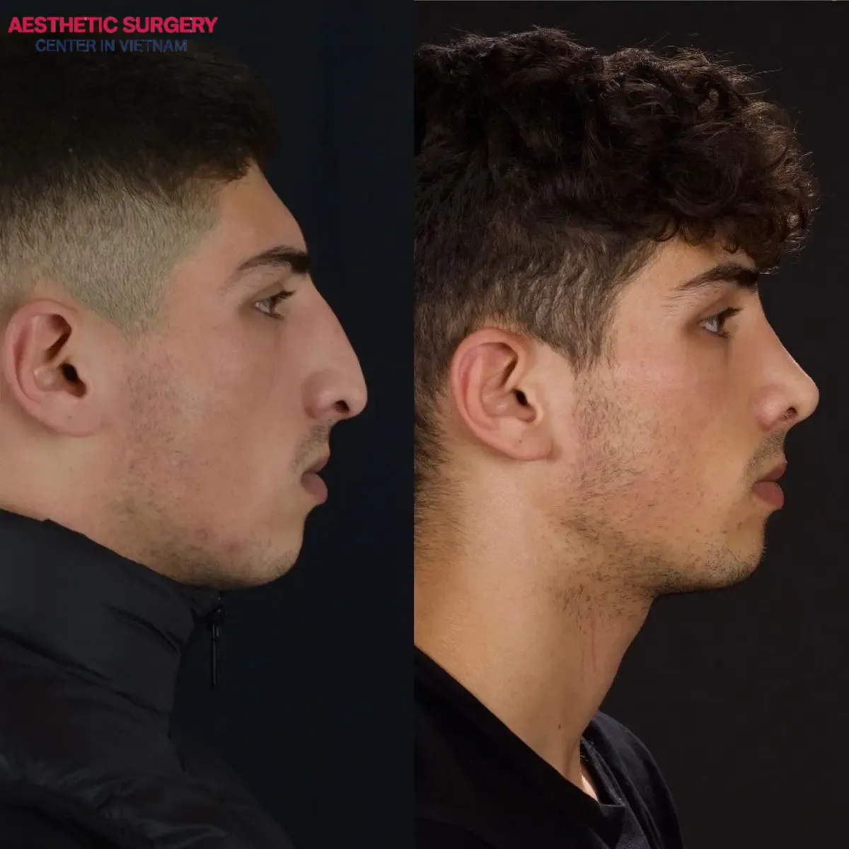 Photo of a man after S-line Rhinoplasty, featuring a high, slim nose and a well-balanced, defined face