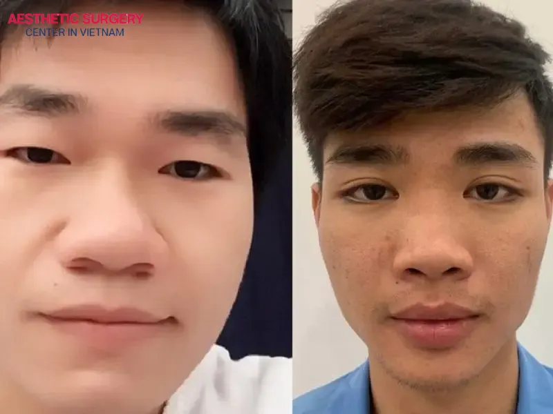 There are various causes of a bulbous nose
