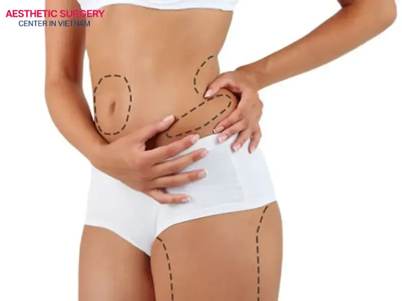 Liposuction is a procedure that removes fat from the body using a cannula, performed by highly skilled surgeons