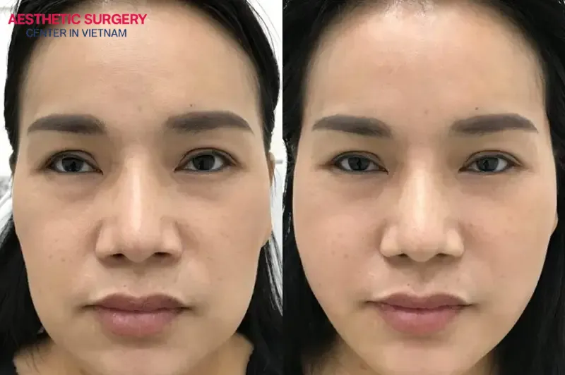 Botox injections help smooth wrinkles, slim the jawline, and enhance your appearance quickly
