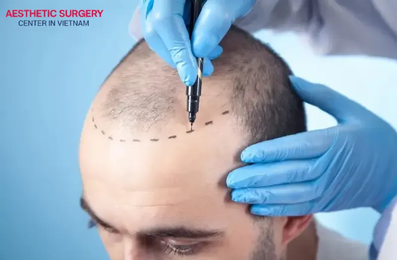 Aesthetic Surgery Center is a trustworthy stem cell hair transplant address in Vietnam