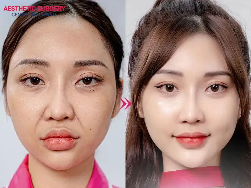Aesthetic Surgery Center is a favorite choice for clients seeking facelift services in Vietnam